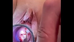 Cervix tor ture w tenaculum sounding Thumb