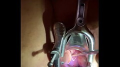 Insertion of sound tenaculum into cervix Thumb