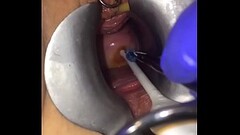 Cervix extreme gyno play Thumb